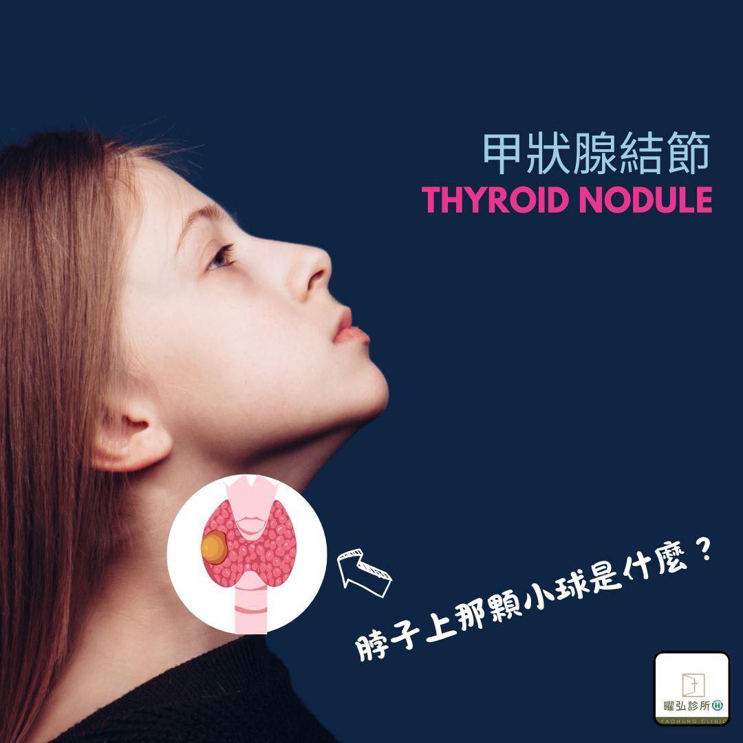 甲狀腺結節